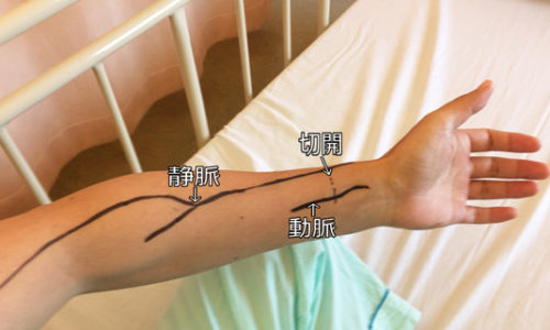 シャント手術