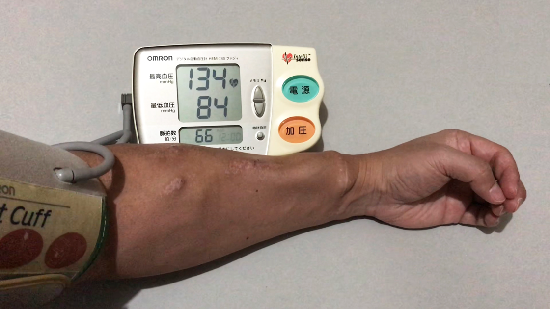 シャント腕側で血圧測定をすること