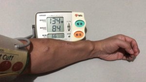 シャント腕で血圧測定をすること