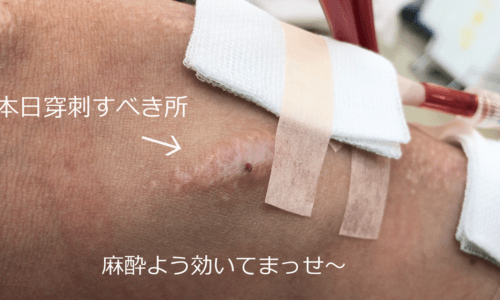 今日の穿刺場所、そこやない～