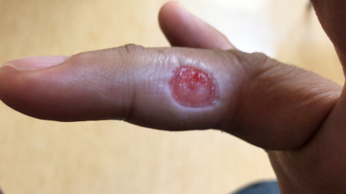右手薬指の尋常性疣贅(ウイルス性イボ)術後一週間