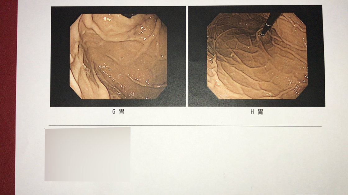 胃カメラ検査の結果（胃4、胃5）