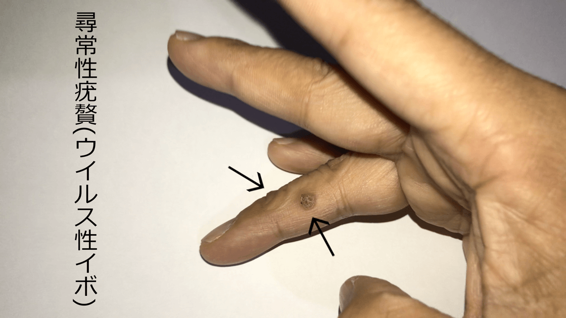 右手薬指に二ヶ所の尋常性疣贅(ウイルス性イボ)