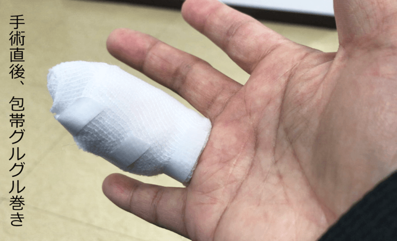 尋常性疣贅(ウイルス性イボ)の手術直後の様子