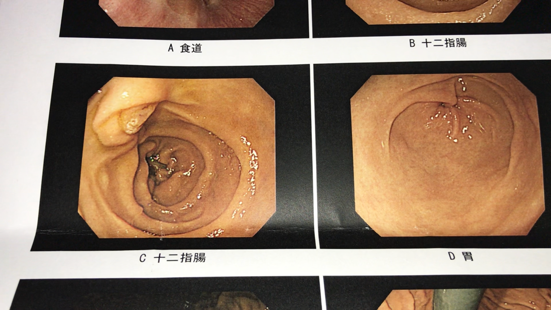 胃カメラ検査の結果（十二指腸2、胃1）