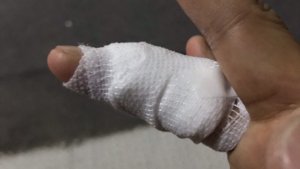 右手薬指の尋常性疣贅(ウイルス性イボ)術後一週間フランクフルト包帯から卒業